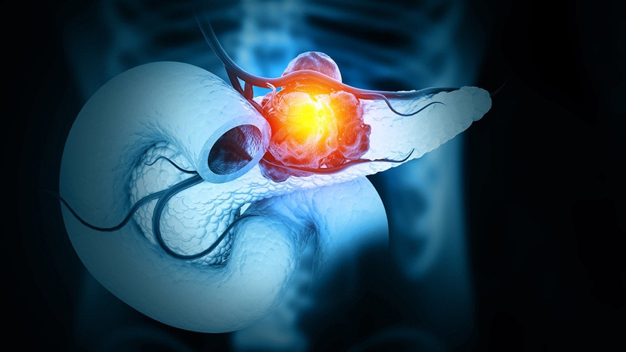 Progress fighting pancreatic cancer, one of the deadliest malignancies